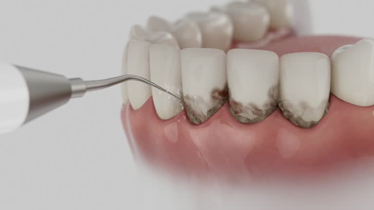 Reliable Dental Implants contractor in Pompano Beach, FL by Smile Center Dentistry